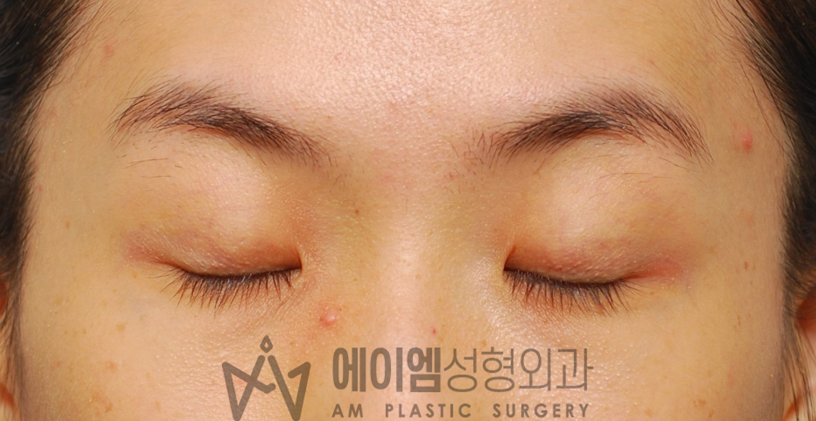 수술 후 4개월 눈감은사진 (쌍수 풀기 후)