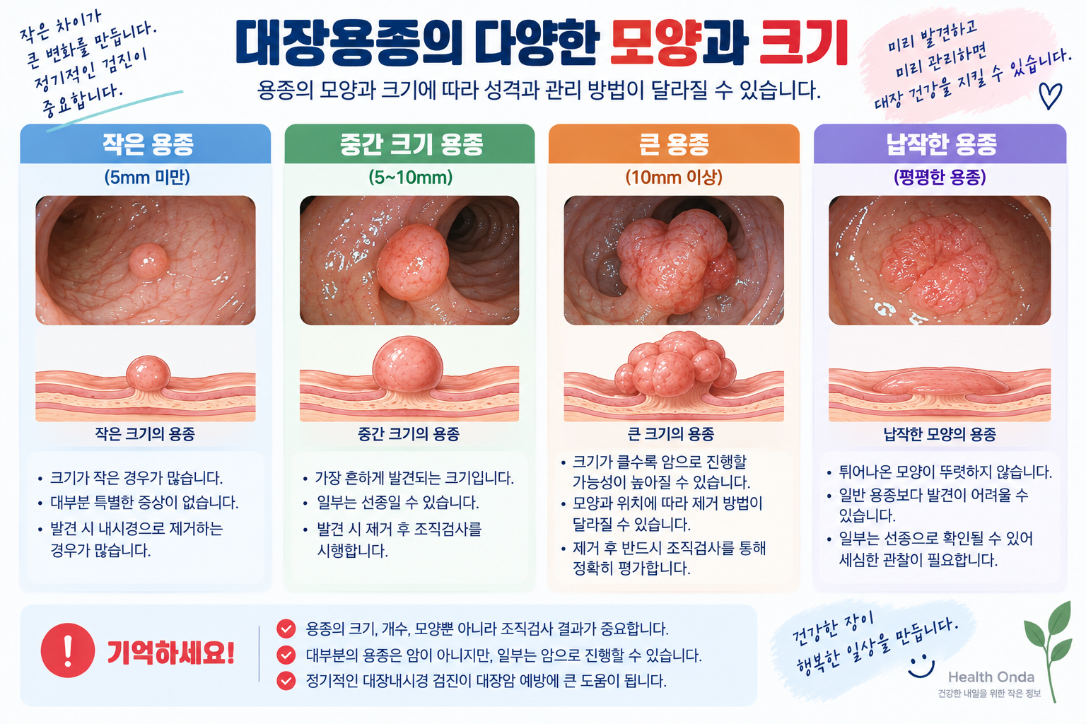 용종의 크기와 모양 차이를 설명하는 예시 그림