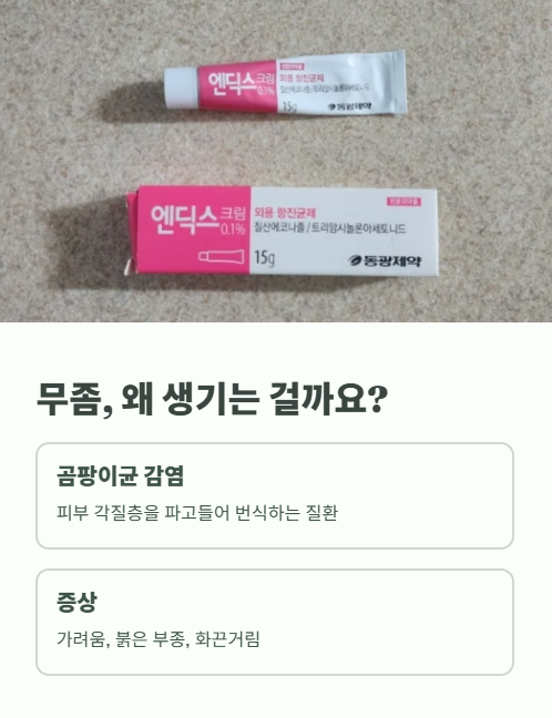 무좀 왜 생기는 걸까요?