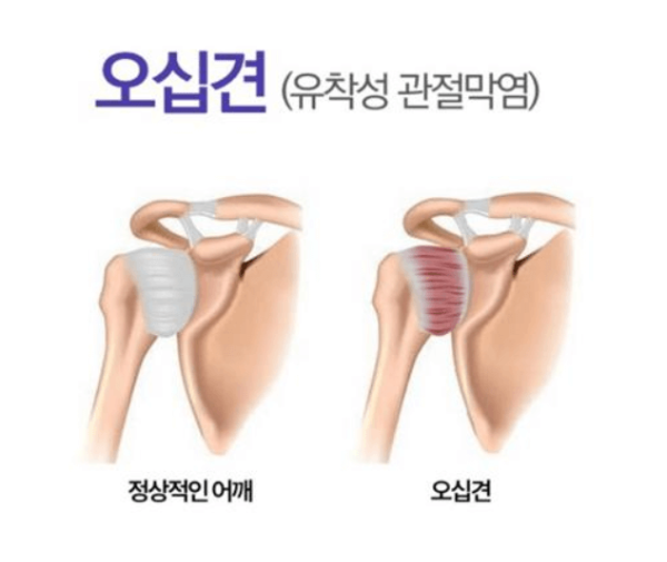 오십견 원인과 증상 완화 운동법 총정리, 정상 어깨와 오십견