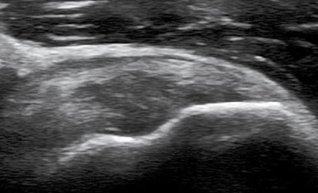 급성 근육손상의 초음파 이미지