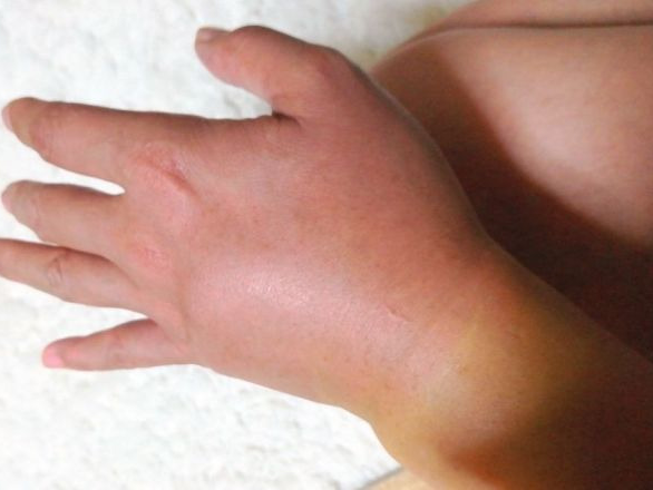 몸이 붓는 원인