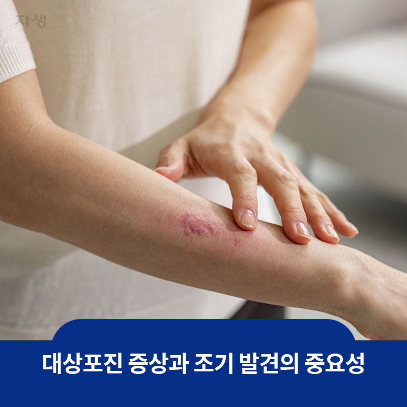대상포진 치료 골든타임 72시간을 사수