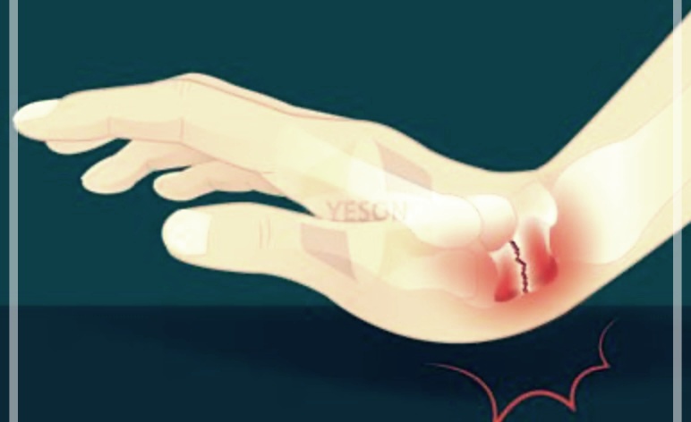 손목 반깁스 하는법