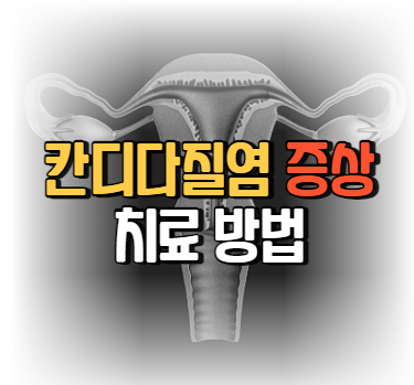 칸디다 질염