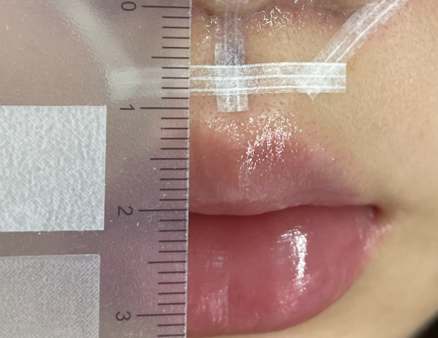 인중 축소 수술 후기