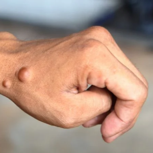 신경섬유종 초기 증상, 혹시 나도? 놓치면 안 되는 신호