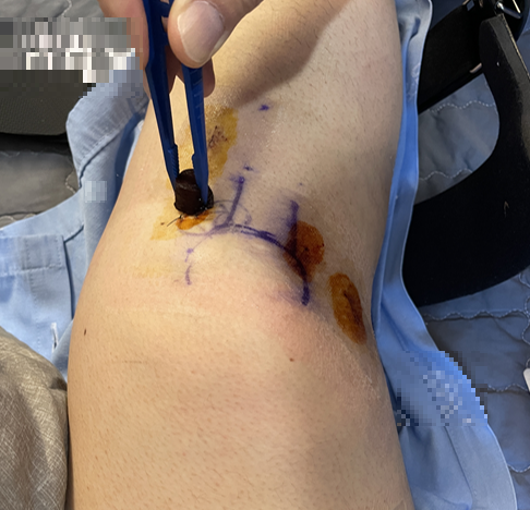 수술 후 입원 중에 소독하는 중