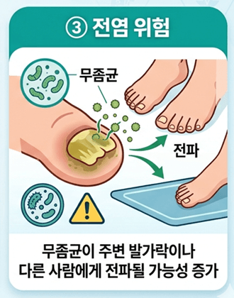 두꺼운 발톱
