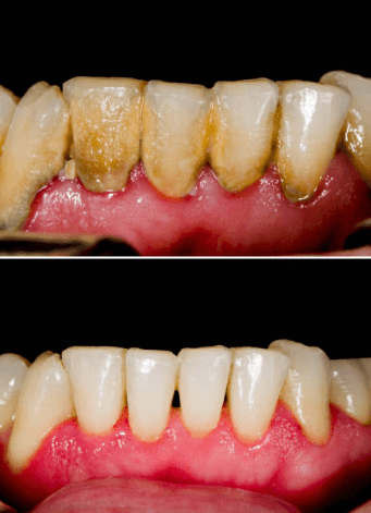 치과 스케일링 가격