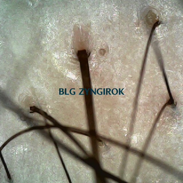 피나모아 복용 22주차 - 정수리와 이마 사이 부분 두피 모습이다.