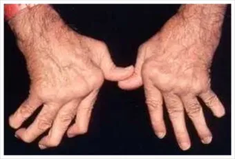 효과적인 류마티스 관절염 치료제 추천 약물 비교 가이드 2025 최신판_11