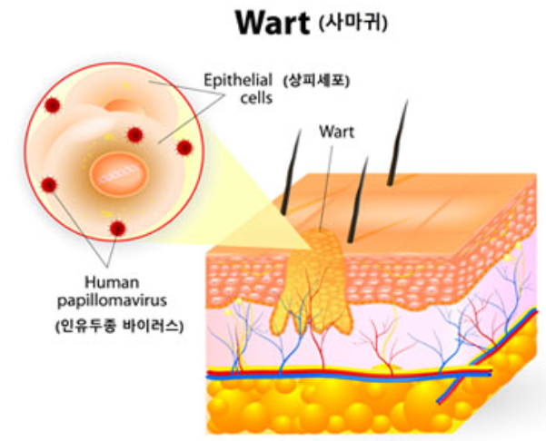 곤지름 사마귀