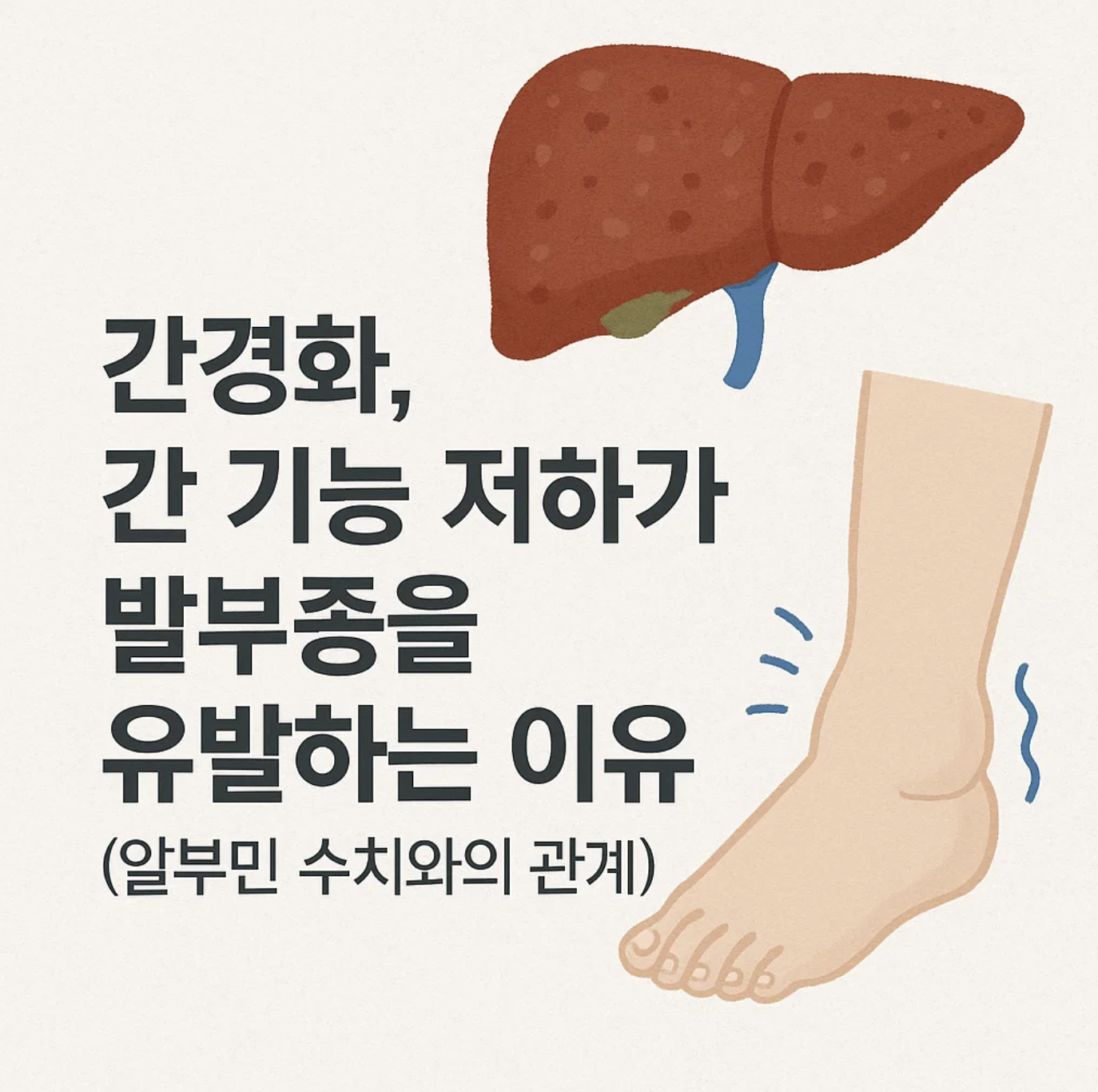 간경화, 간 기능 저하가 발부종을 유발하는 이유 (알부민 수치와의 관계)