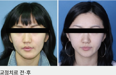 교정하면 안되는 이유