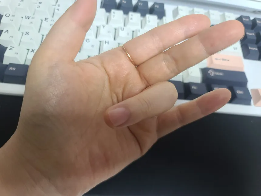 방아쇠 수지 증후군 원인