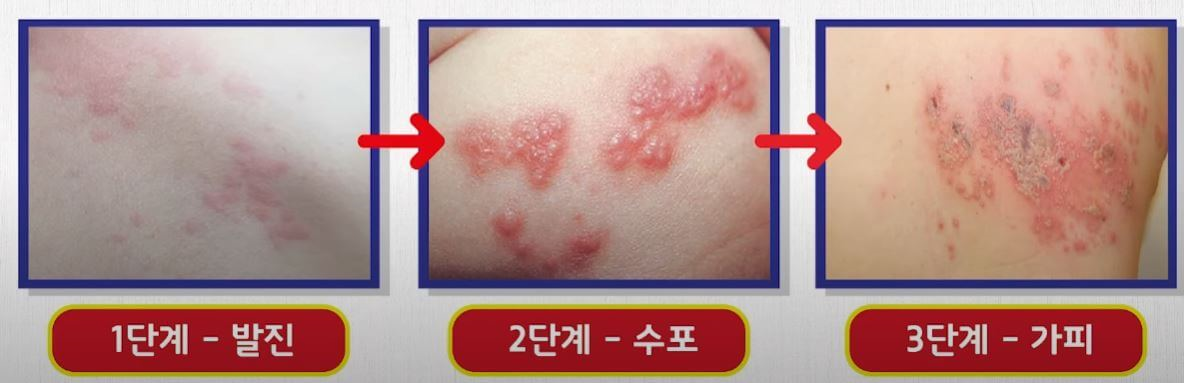 대상포진 초기, 중기, 말기 사진