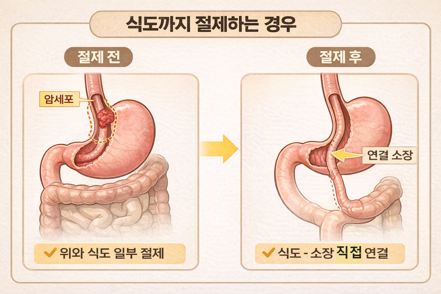 위암 수술 시 식도 일부 절제와 소장 연결 구조를 설명하는 의료 이미지