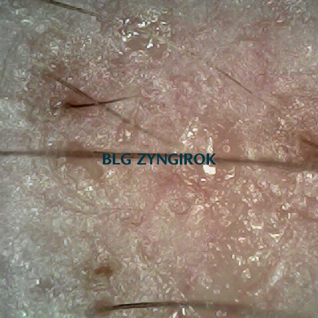 탈모 극복 프로젝트 - 오른쪽 M자 부위 두피 모습이다.