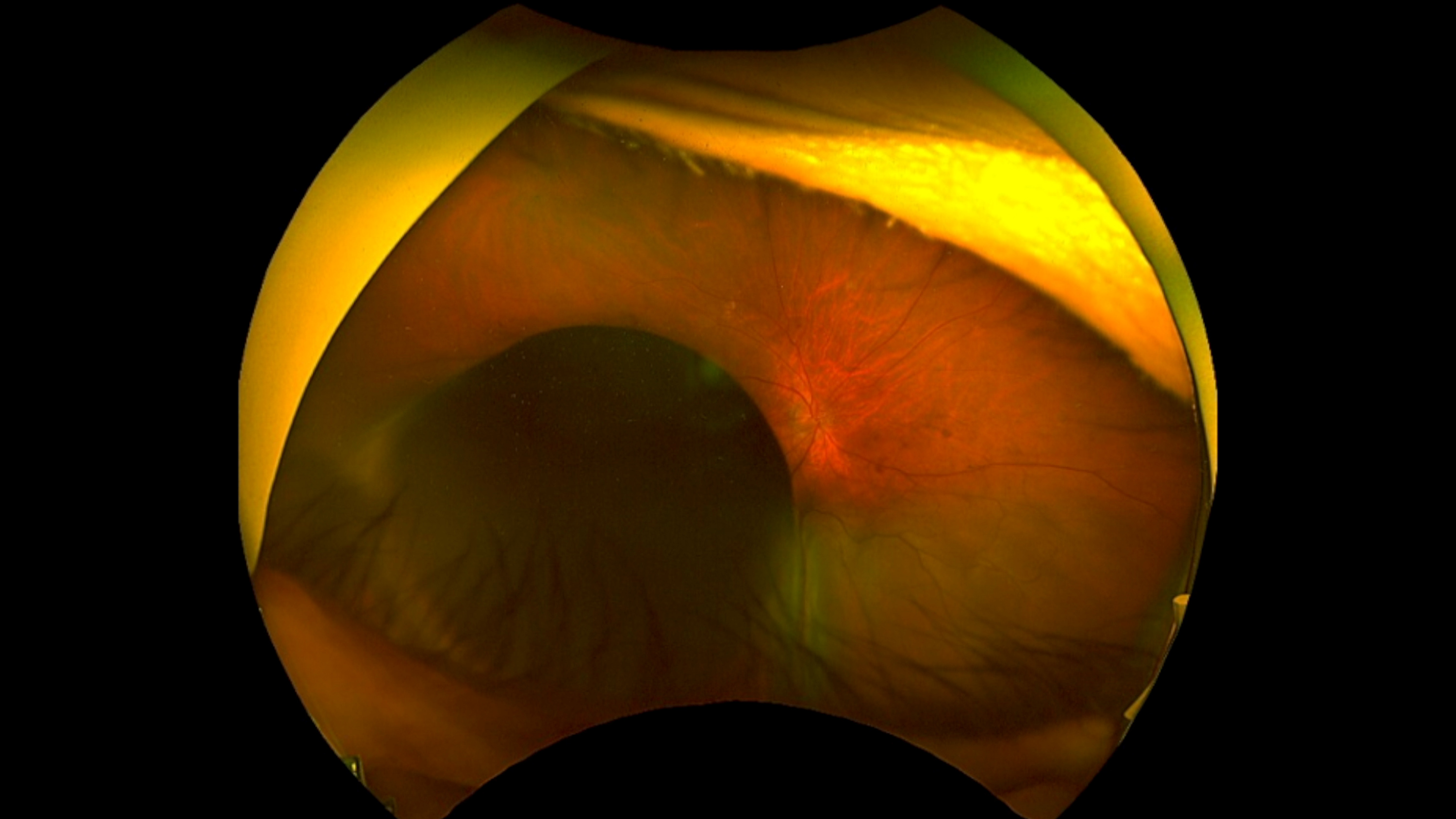 명의 눈속의 점 안구 종양