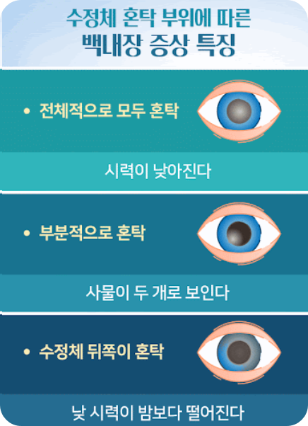 백내장실비후기4