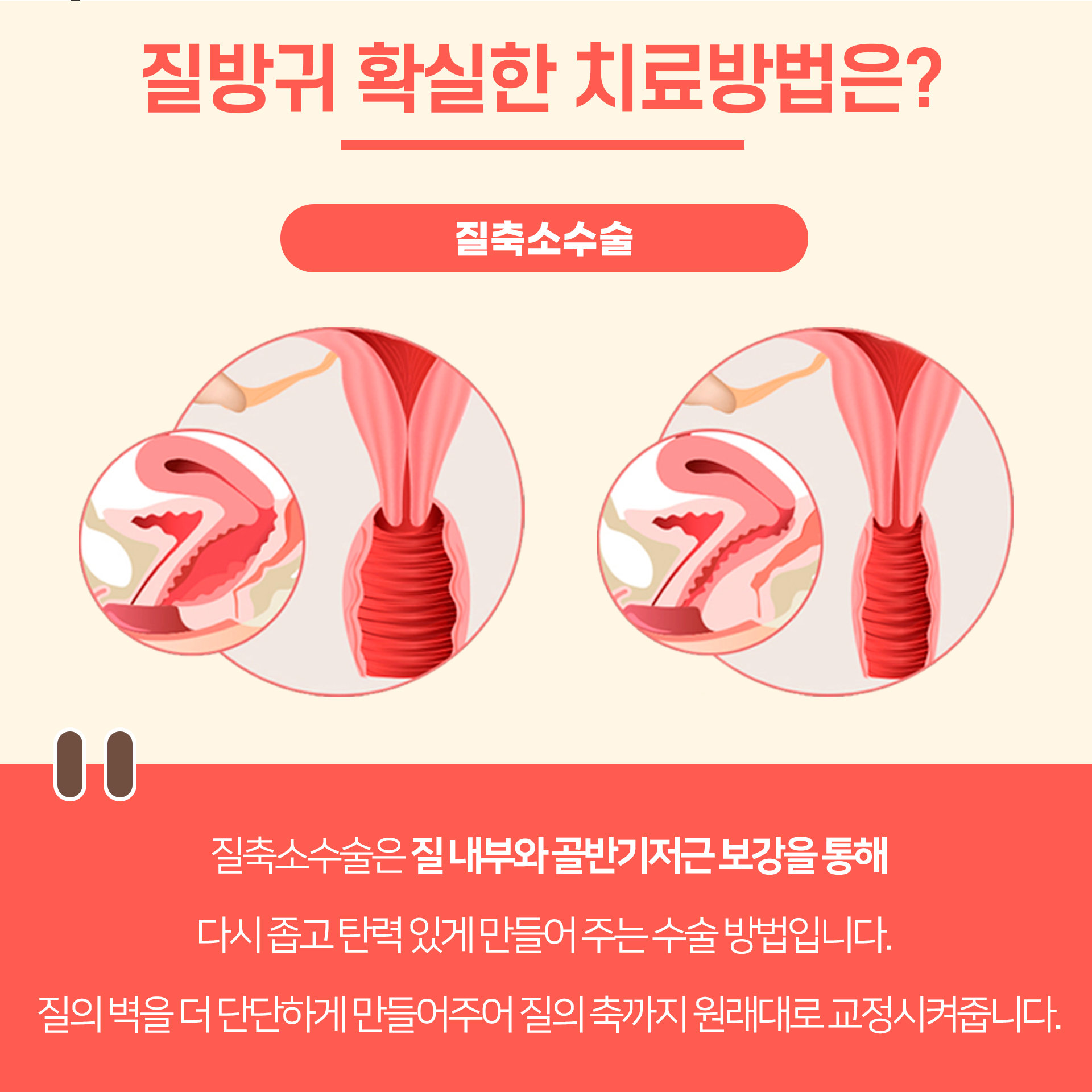 성감저하 확실한 치료법은?