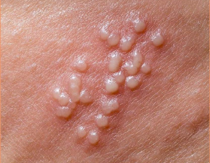 헤르페스 2형 원인 증상 01