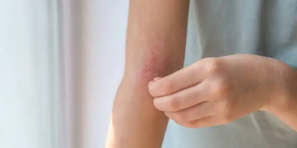 아토피 피부 건강유지