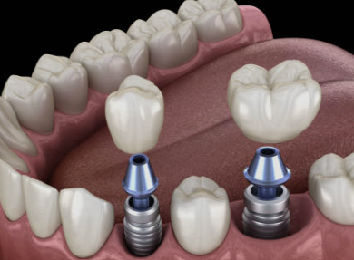 임플란트 가격 확인 최저가 확인 시술기간 (최신)