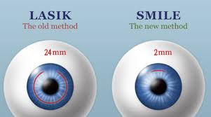 라식과 라섹 차이점