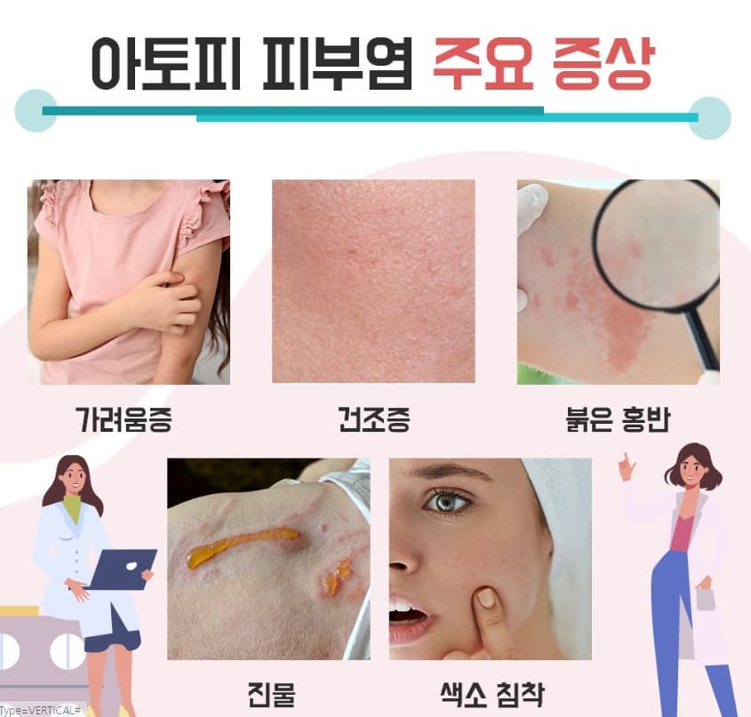 아토피 피부염