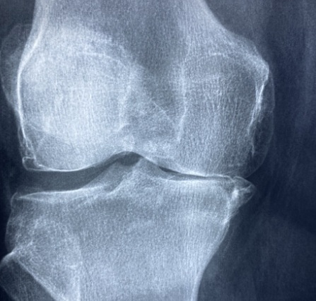 무릎관절염이 진행된 뼈의 모습