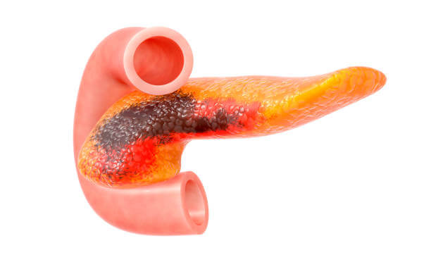 췌장암 의심증상 9가지