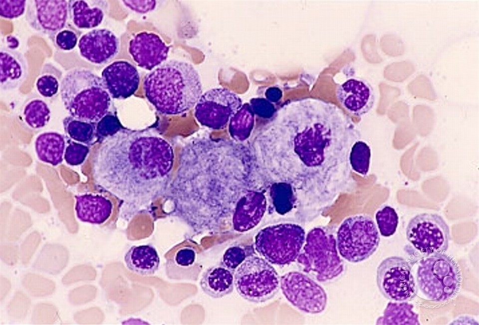 고셔세포를 현미경으로 촬영