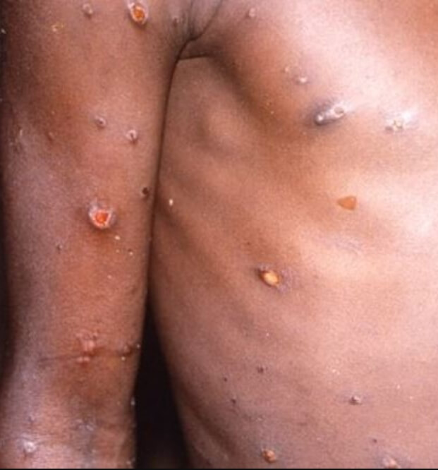 원숭이 두창 관련주 원숭이 두창이란?