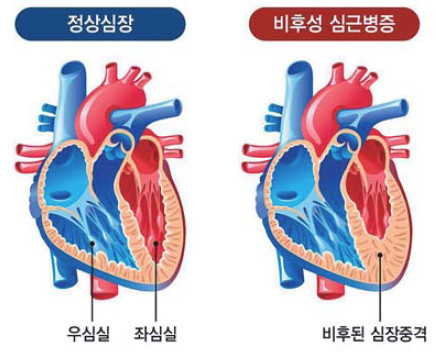 비후성 심근증