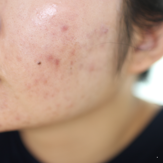 여드름 후유증으로 남은 홍반&amp;#44; 효과적인 관리법은?