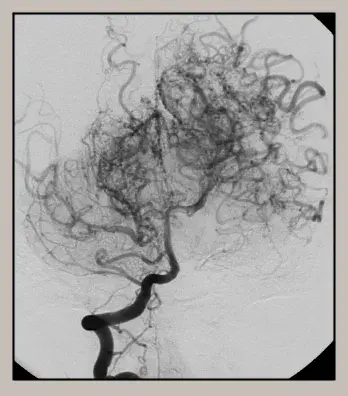 모야모야병-정의