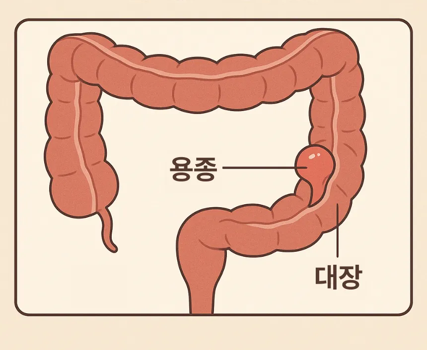 대장 용종