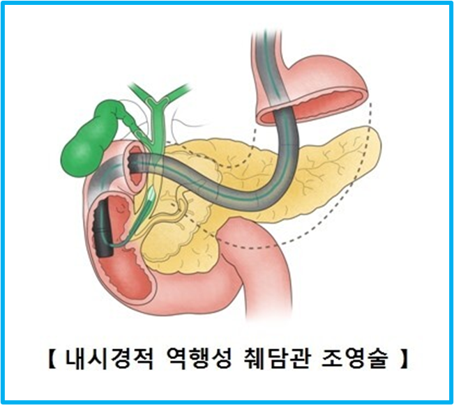 내시경적 역행성 취담관 조영술