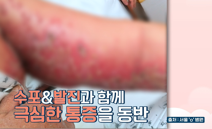 대상포진