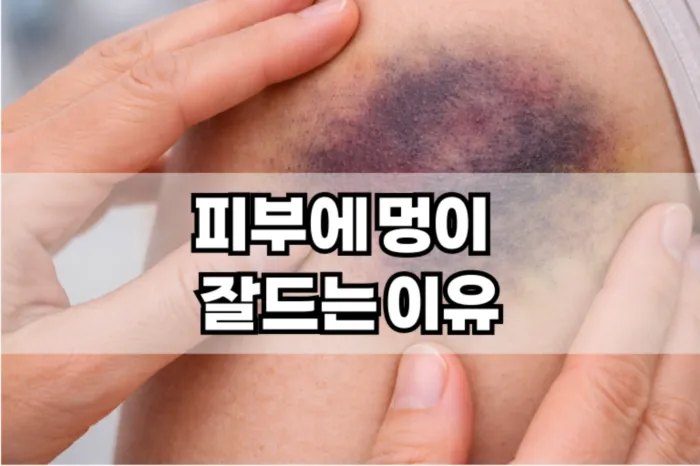 피부에 멍이 잘드는 이유
