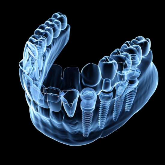 임플란트 시술과정 단계별 ㅣ 정부지원 받는방법