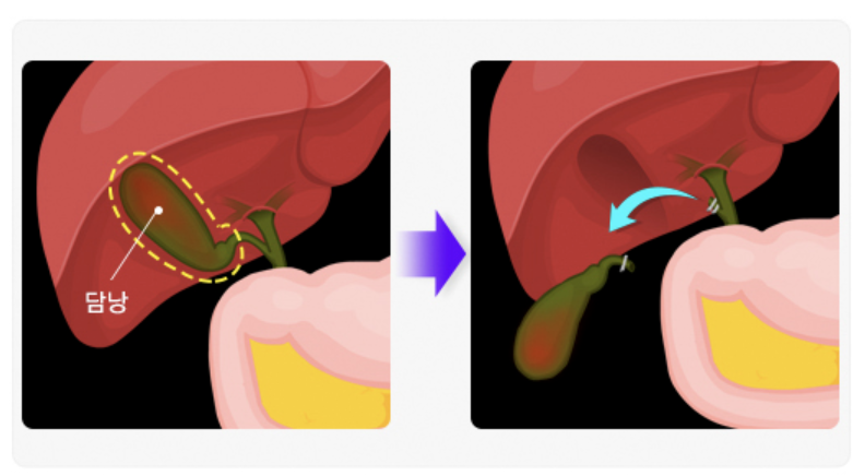 담낭염의 증상 2