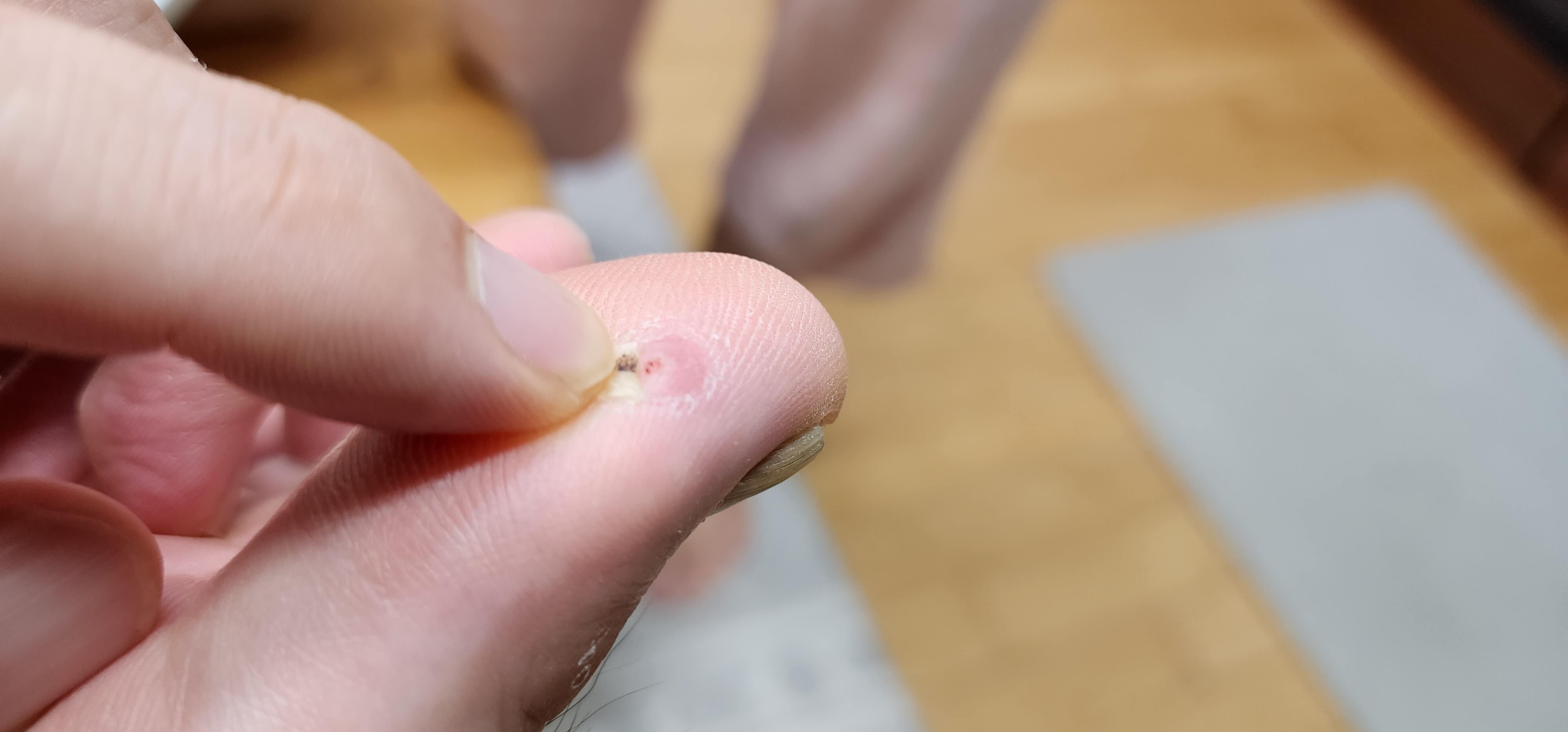 사마귀가떨어져 나간모습