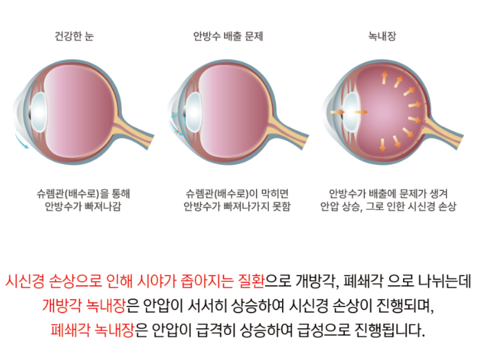 녹내장 원인
