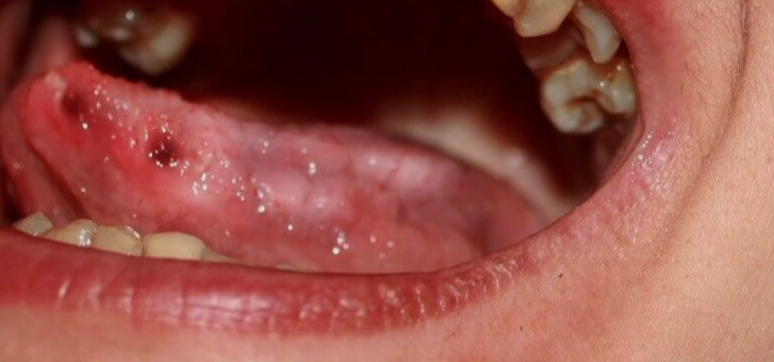 혓바닥에-관련된-병