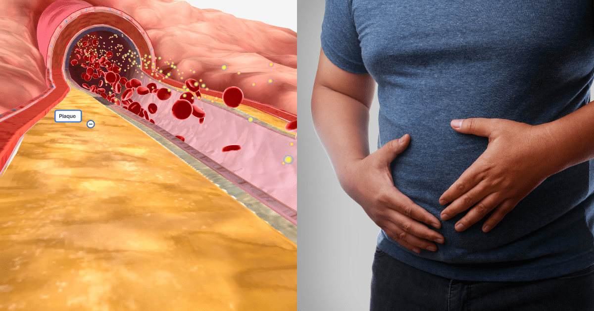 혈관이 지방으로 막히는 단면과 배를 잡고있는 뚱뚱한 남성의 몸체