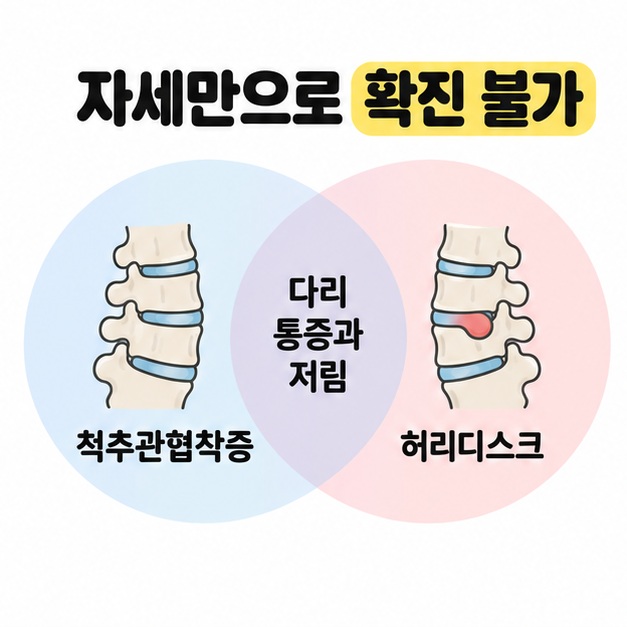 척추관협착증과 허리디스크를 나타낸 두 원의 겹치는 부분에 다리 통증과 저림을 배치하고 자세만으로 확진할 수 없다고 설명한 도식