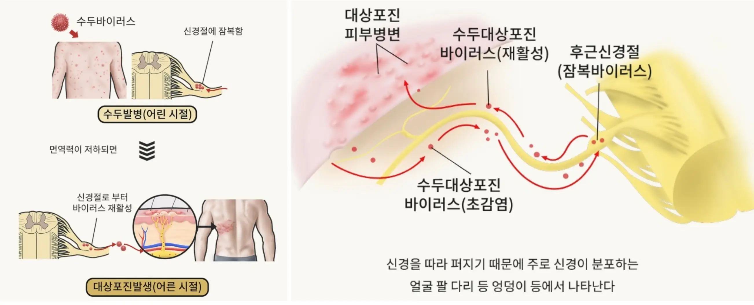 대상포진 증상